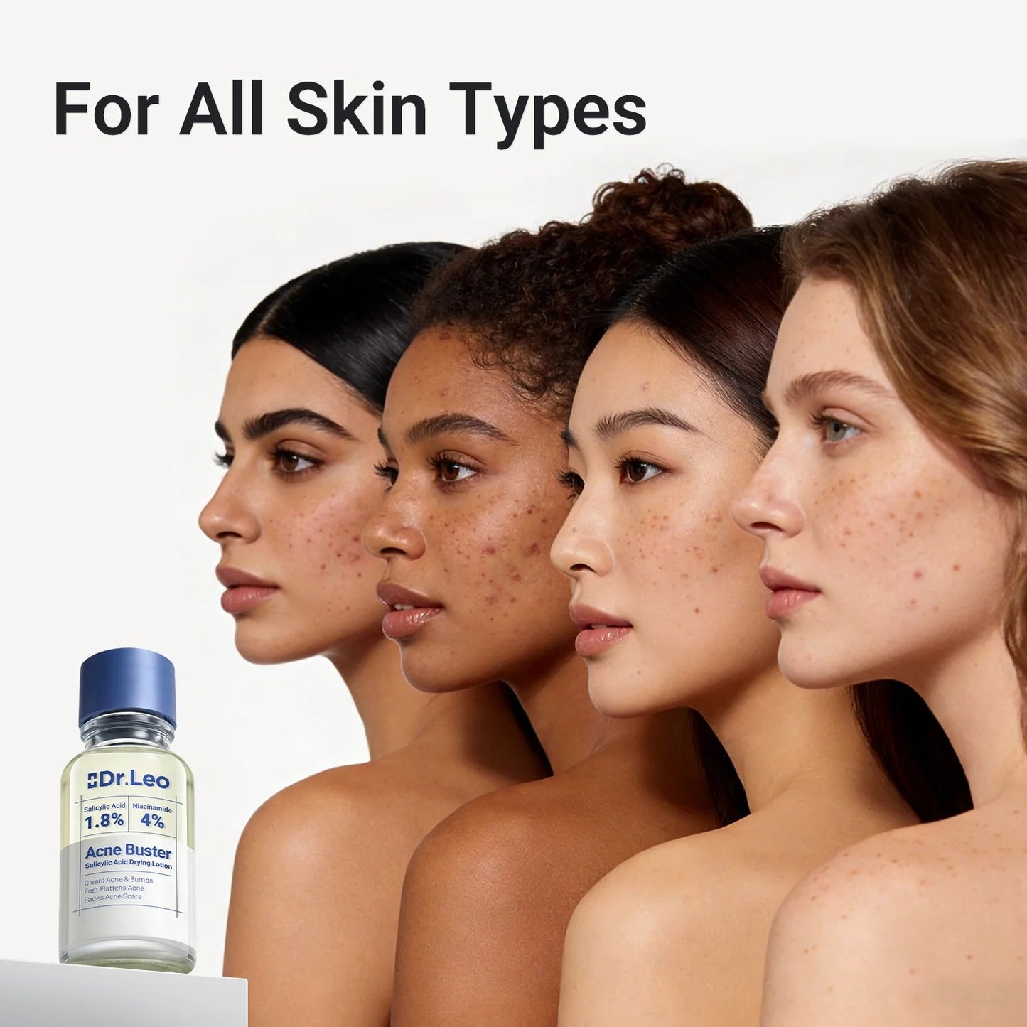 Acne Drying Lotion Plus (1.8% Encapsulated Salicylic Acid) — 10 mL