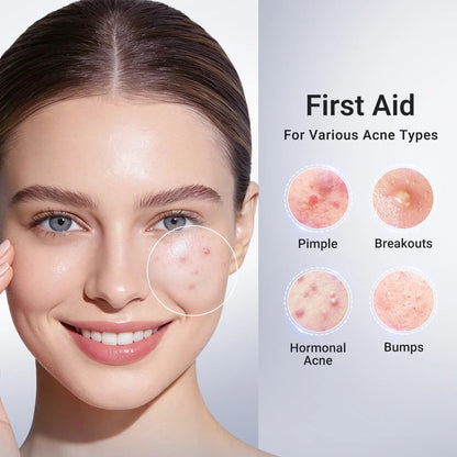 Acne Drying Lotion Plus (1.8% Encapsulated Salicylic Acid) — 10 mL